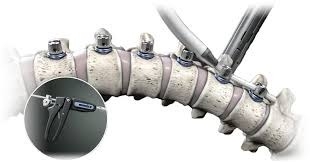 VBT (Vertebral Body Tethering)