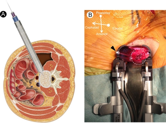 OLIF (Oblique Lateral Interbody Fusion)